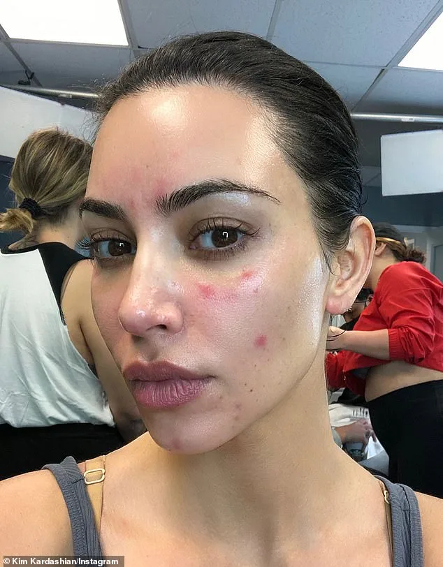 Surge in Psoriasis Cases in the UK: Social Stigma and the Need for Greater Awareness