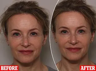 Surge in Psoriasis Cases in the UK: Social Stigma and the Need for Greater Awareness