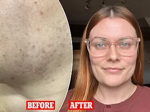 Aida Azizii's PCOS Journey: A Breakthrough with Inositol