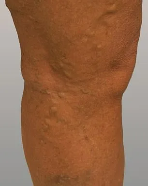 Varicose Veins: Beyond Aesthetics, A Silent Health Crisis