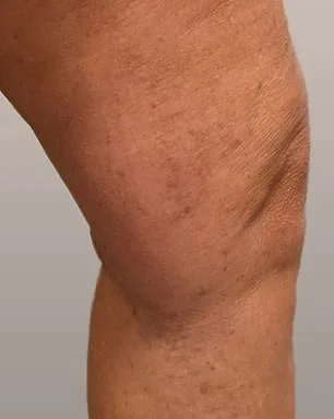 Varicose Veins: Beyond Aesthetics, A Silent Health Crisis