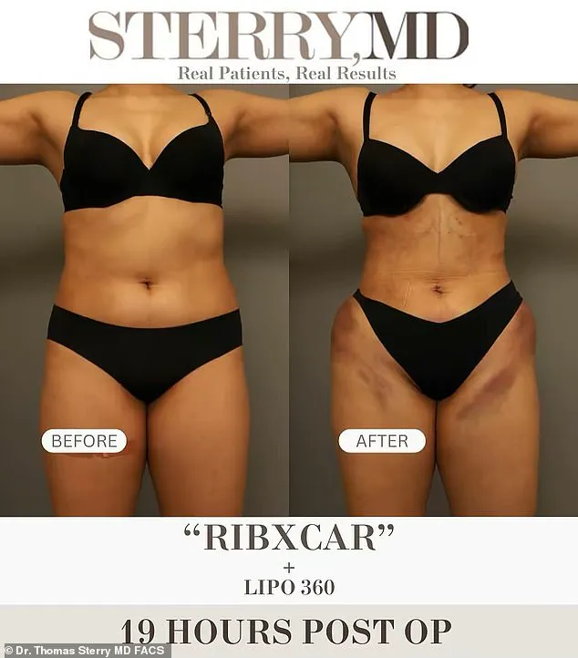 Exclusive Access: Dr. Sterry Reveals New Procedure For Redefining Waistlines