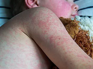 Houston Reports Measles Case in Unvaccinated Infant as Outbreak Concerns Persist