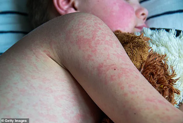 Houston Reports Measles Case in Unvaccinated Infant as Outbreak Concerns Persist