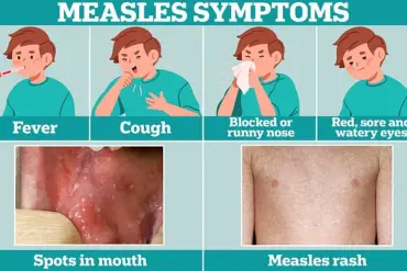 Measles Alert Issued in Washington D.C. After Confirmed Case Visits Multiple Public Locations