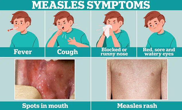 Measles Alert Issued in Washington D.C. After Confirmed Case Visits Multiple Public Locations