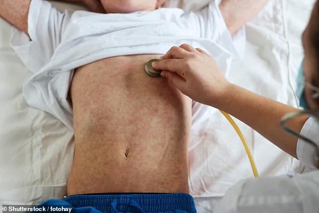 Measles Outbreak Fears Mount at Washington Dulles International Airport