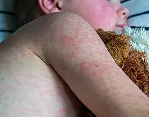 Measles Outbreak Highlights Urgency of Vaccine Compliance and Public Health Measures