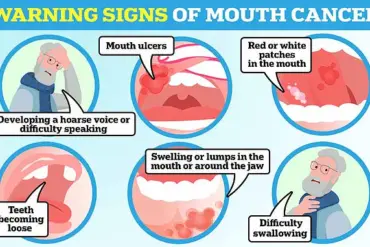Sugar-Sweetened Drinks Linked to Higher Risk of Oral Cancer: New Study Warns