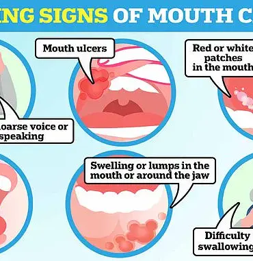 Sugar-Sweetened Drinks Linked to Higher Risk of Oral Cancer: New Study Warns