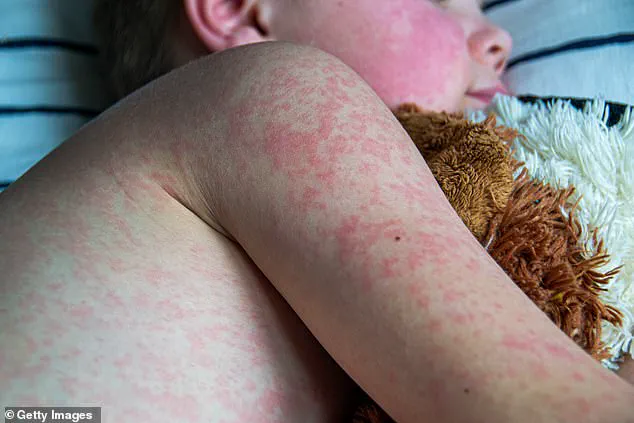 Two Deaths Reported in West Texas Measles Outbreak