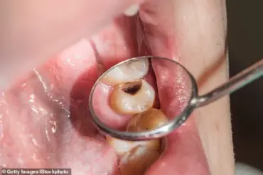 Dental Deserts Plague Over 25 Million Americans as Fluoride Removal Threatens Oral Health