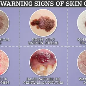 NHS Set to Revolutionize Cancer Care with Needle-Free Vaccine for Advanced Melanoma Patients