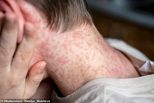Robert F Kennedy Jr Reverses Stance, Endorses MMR Vaccine Against Measles