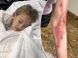 TikTok Mom Hannah Campbell Shares Heartbreaking Announcement of Daughter Elliana's Passing Due to Rare Skin Condition