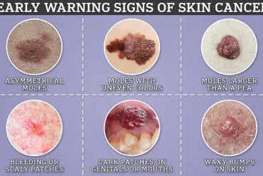 Top Cancer Doctor Urges Public Awareness of Early Warning Signs for Cancer