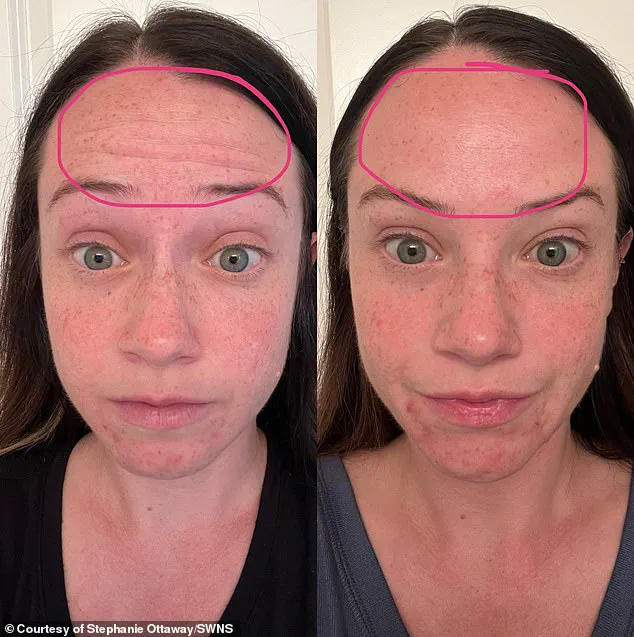 Beauty’s Price: How a Cosmetic Procedure Left a Mother Temporarily Paralyzed and Battling a Rare Neurological Condition