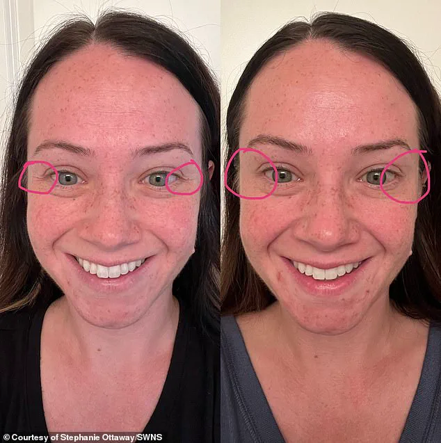 Beauty’s Price: How a Cosmetic Procedure Left a Mother Temporarily Paralyzed and Battling a Rare Neurological Condition