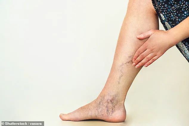Credible Study Links Varicose Veins to Dementia Risk, Experts Urge Public Awareness