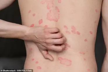 New Research Reveals Urgent Link Between Abdominal Fat and Psoriasis, Prompting Calls for Revised Healthcare Strategies