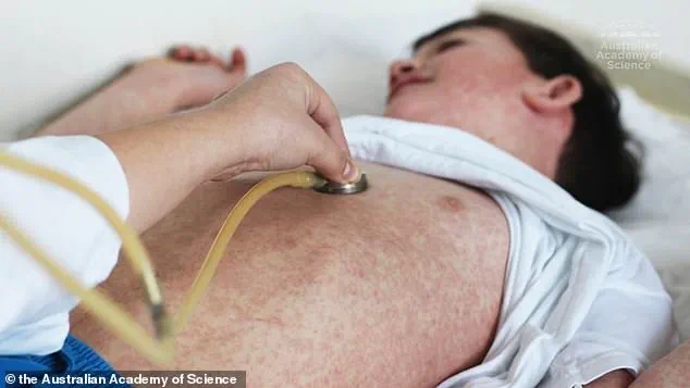 Urgent Alert: 30,000 Measles Deaths Projected in 25 Years if Vaccine Rates Continue to Drop