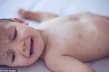 Urgent Public Health Alert: Measles Resurgence Sparks Expert Warnings on Vaccine Access and Child Safety