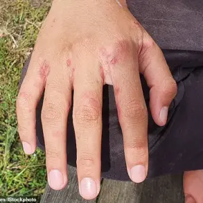 Urgent Warning: Holidaymakers Risk Scabies by Leaving Luggage on Hotel Beds, Expert Warns
