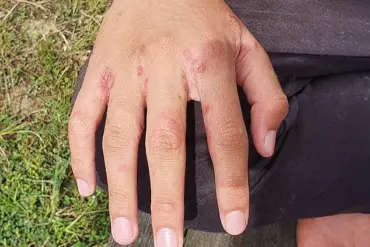 Urgent Warning: Holidaymakers Risk Scabies by Leaving Luggage on Hotel Beds, Expert Warns