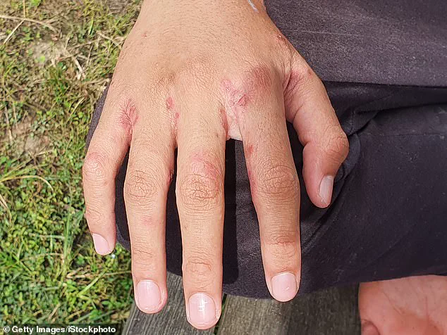 Urgent Warning: Holidaymakers Risk Scabies by Leaving Luggage on Hotel Beds, Expert Warns