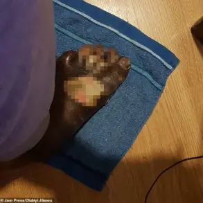 A DIY Pedicure's Peril: How a Himalayan Salt Bath Left a Man with Severe Burns