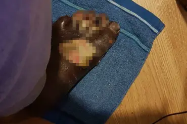 A DIY Pedicure's Peril: How a Himalayan Salt Bath Left a Man with Severe Burns