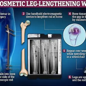 From 5'6'' to 6'3'': How Leon Otremba's Height-Enhancing Surgeries Sparked Global Debate on Identity and Medical Innovation