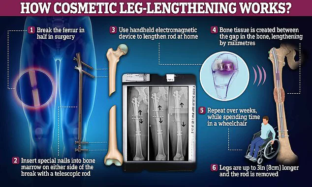 From 5'6'' to 6'3'': How Leon Otremba's Height-Enhancing Surgeries Sparked Global Debate on Identity and Medical Innovation