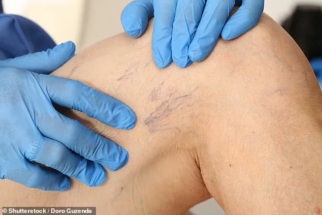 Late-Breaking Update: Dr. Ellie Cannon Issues Urgent Advice on Thread Vein Concerns