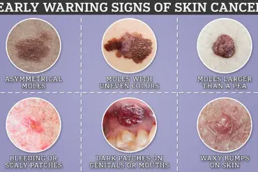 Unseen Dangers: Recognizing Atypical Melanoma Signs to Protect Communities