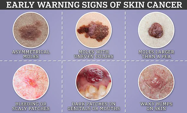 Unseen Dangers: Recognizing Atypical Melanoma Signs to Protect Communities