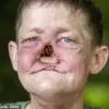 William Brogan's Cancer Battle Sparks Conversation on Early Diagnosis and Facial Reconstruction Challenges