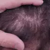 Surge in Unlicensed Hair Transplants in the UK Sparks Alarms Over Black Market Procedures and Patient Risks