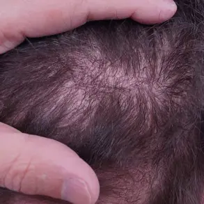Surge in Unlicensed Hair Transplants in the UK Sparks Alarms Over Black Market Procedures and Patient Risks