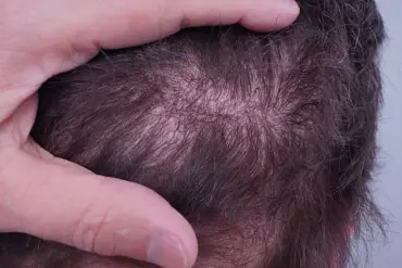 Surge in Unlicensed Hair Transplants in the UK Sparks Alarms Over Black Market Procedures and Patient Risks