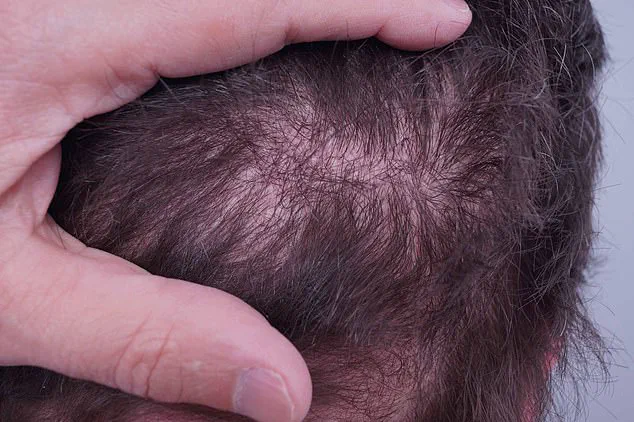 Surge in Unlicensed Hair Transplants in the UK Sparks Alarms Over Black Market Procedures and Patient Risks