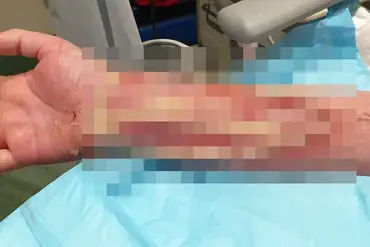 The Hidden Dangers of Dog Ownership: A Life-Threatening Infection from a Minor Bite