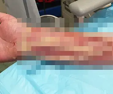 The Hidden Dangers of Dog Ownership: A Life-Threatening Infection from a Minor Bite