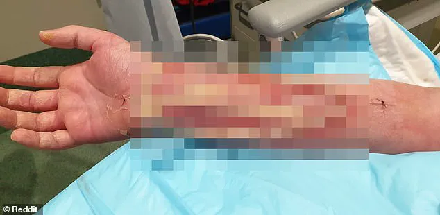 The Hidden Dangers of Dog Ownership: A Life-Threatening Infection from a Minor Bite