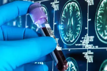Landmark Trial Aims to Revolutionize Alzheimer's Diagnosis with Non-Invasive Blood Test for Early Detection