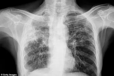 Public Health Teams Mobilized in Maine as TB Cases Spark Health Advisories