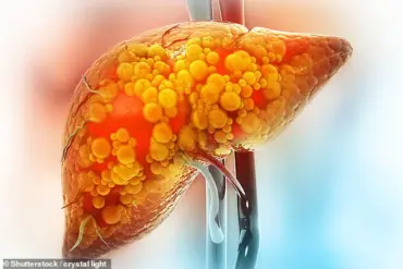 Study Links Harmful Gut Bacteria to Rise in Deadly Liver Cancer, Challenging Traditional Views on Disease Causes